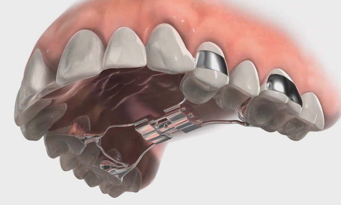 palatal expander